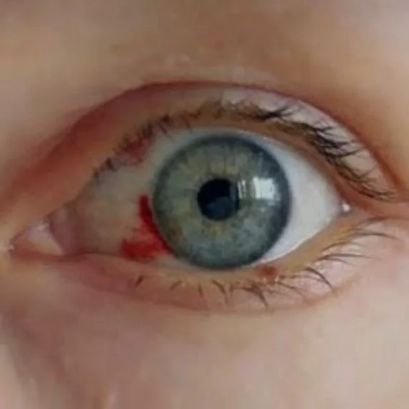 "Kanayan göz virüsü" nedeniyle dünya teyakkuzda!