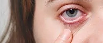 "Kanayan göz virüsü" nedeniyle dünya teyakkuzda!