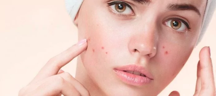 Adet döneminde çıkan sivilce nasıl geçer?