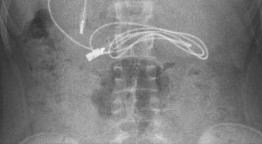 Hepsi 15 yaşındaki çocuğun midesinden çıktı!