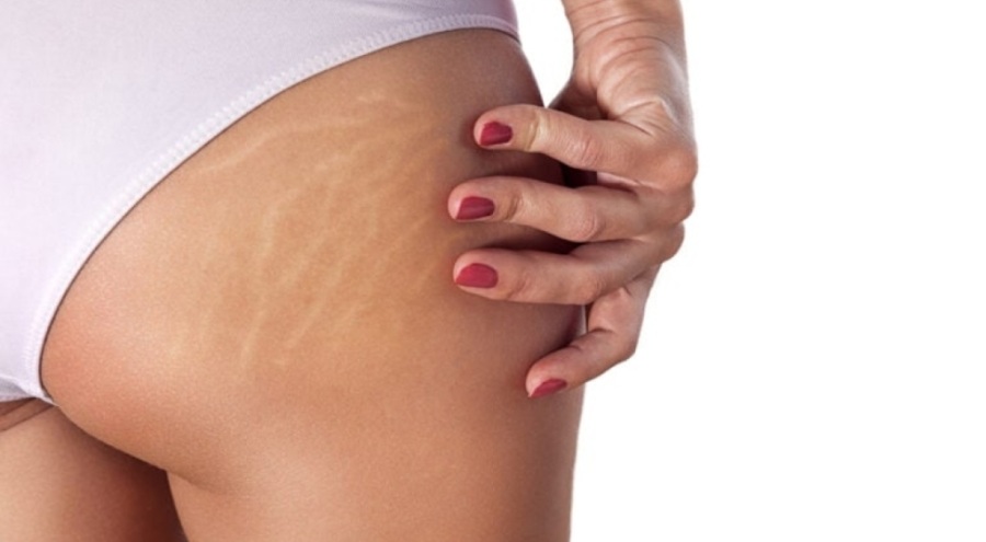 Selüliti olanlar sakın bu yiyecekleri tüketmeyin!