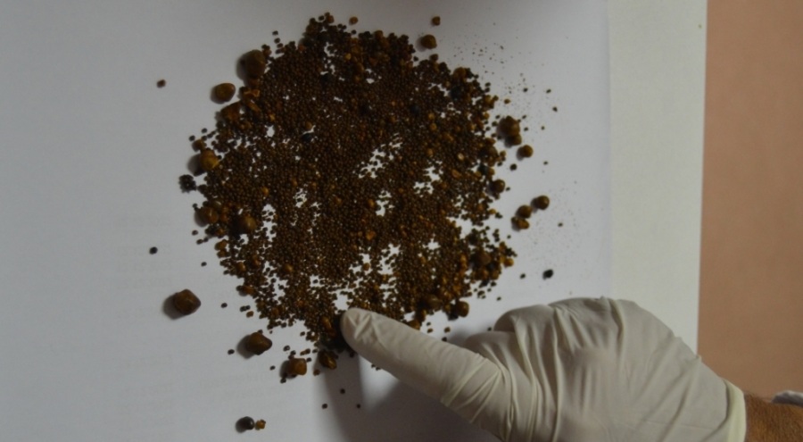 Safra kesesinden 4 bin 536 tane taş çıktı