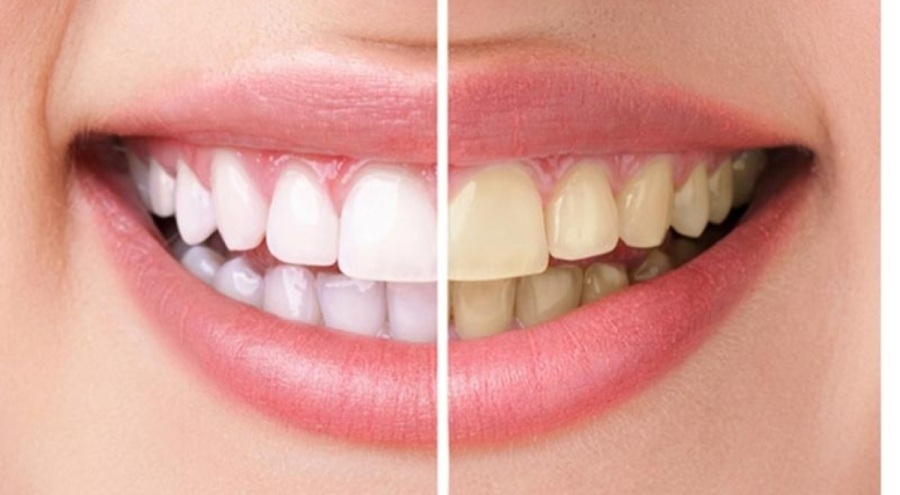 Diş beyazlatma zararlı mı?