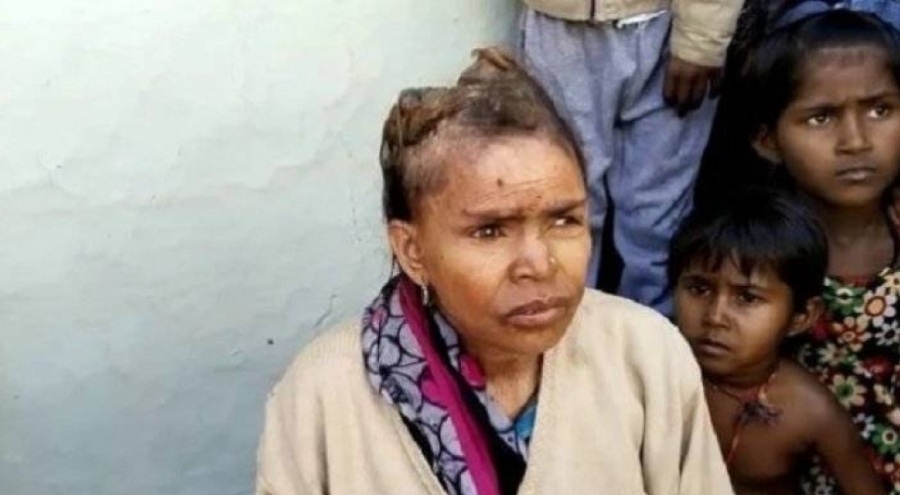 Hindistan'da bir kadının kafasında boynuzlar çıkıyor