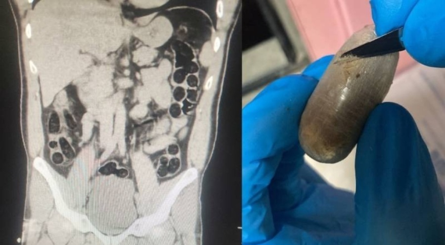 İranlı yolcunun midesinden 714 gram eroin çıkarıldı