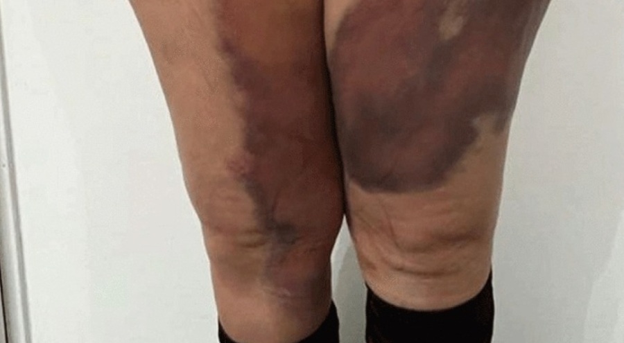 Türkiye'ye gelip yağlarını aldıran kadının operasyon sonrası vücudundaki morluklar geçmedi