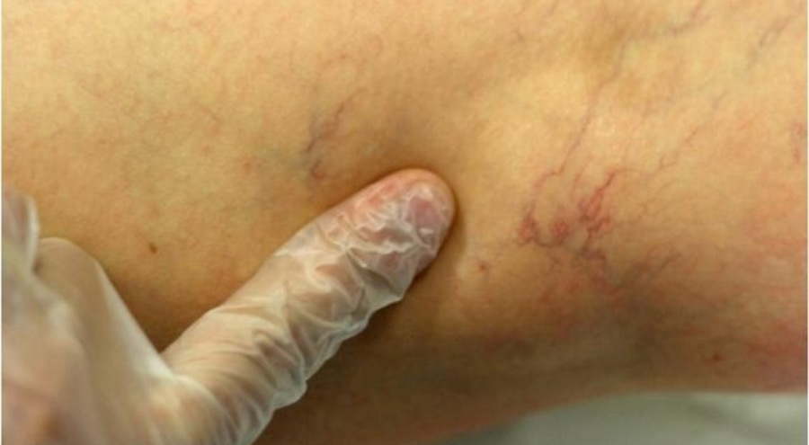 15-20 dakikada çözülüyor... Varisin tedavisi mümkün!