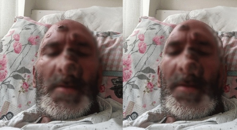 Sinek ısırığı tanınmayacak hale getirdi!