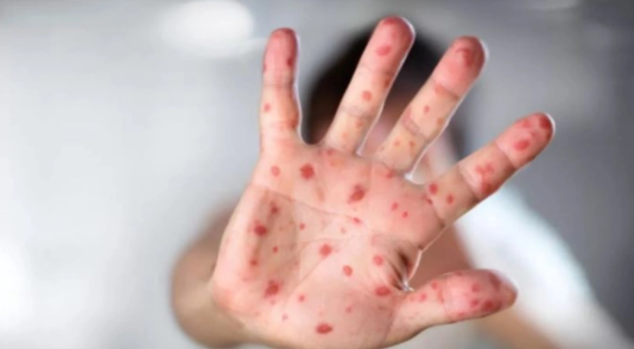 ABD'de kızamık alarmı! 20 bin kişi risk altında