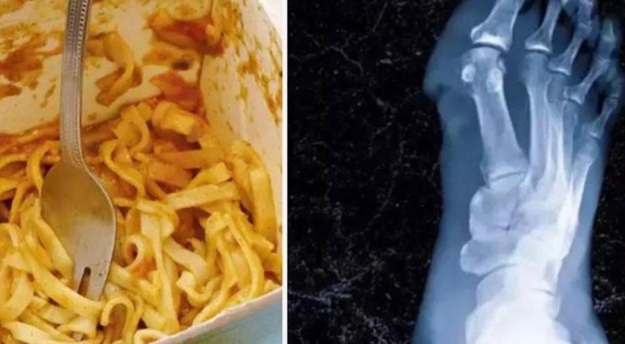 Öğrenci bozuk erişte yedi: Elleri ve bacakları kesildi!