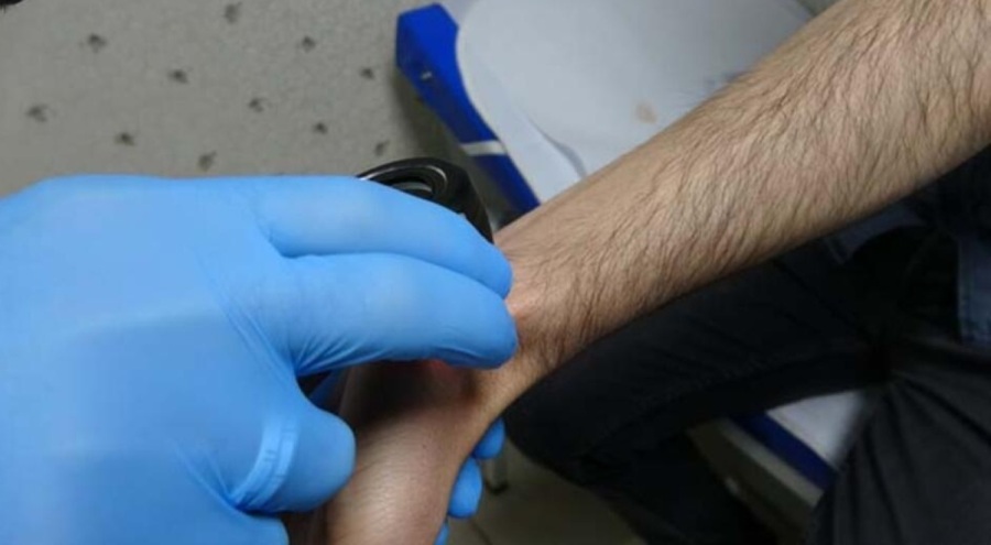 Kovid-19 uyuz hastalığını tetikledi