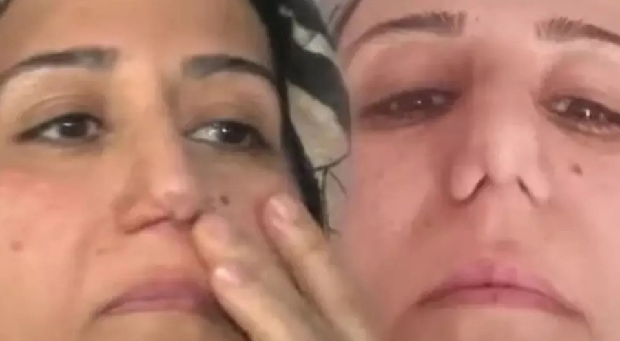 Burun estetiği yaptıran kadın aynaya bakınca büyük bir şok yaşadı!