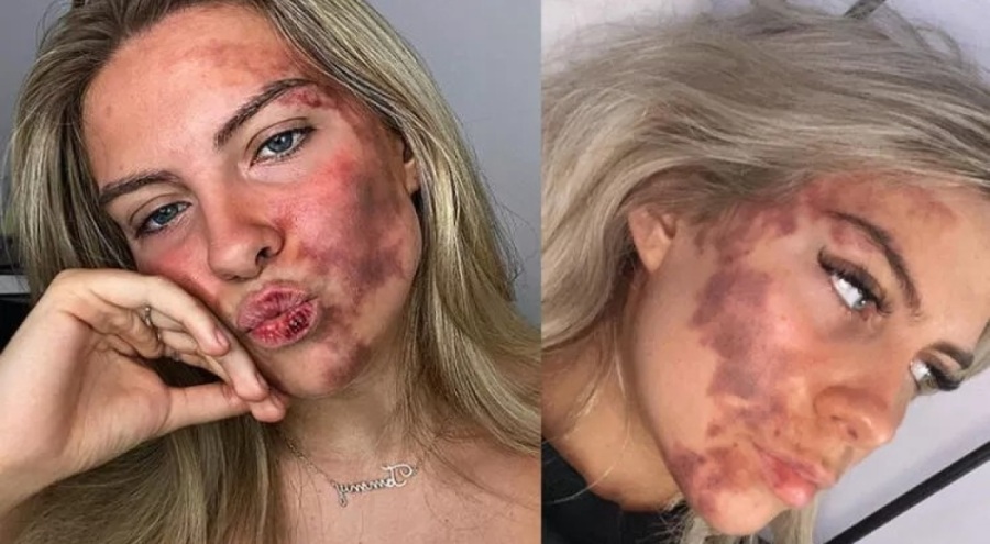 Dudağındaki morluk yüzüne yayıldı!