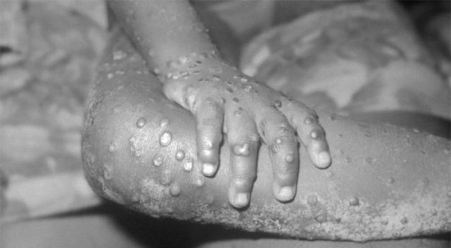 Pakistan'da ilk maymun çiçeği vakası tespit edildi