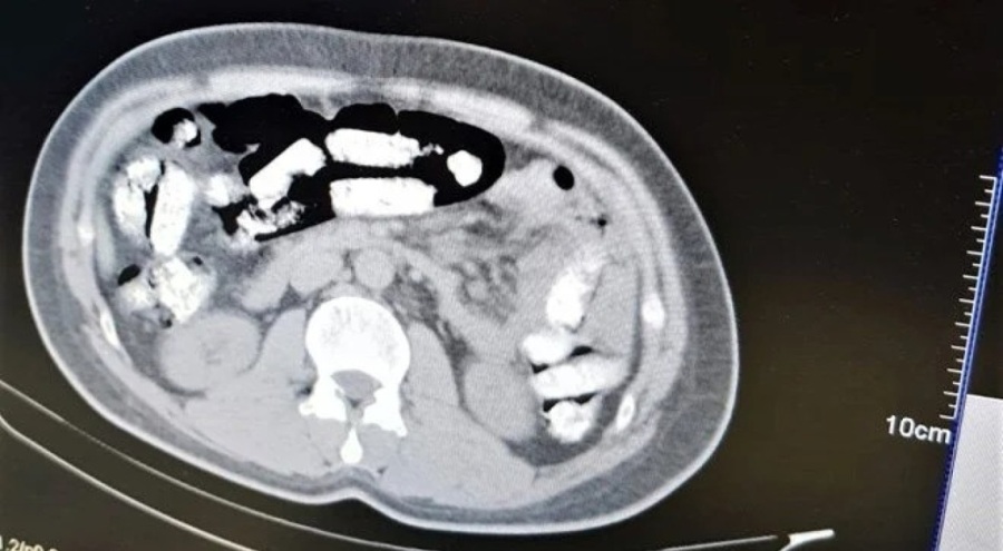 Erzincan'da midesinde uyuşturucu sevkiyatı yaparken yakalandı