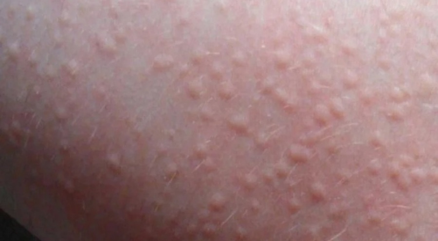 Uzmandan uyarı: Bahar aylarında ürtikere dikkat!