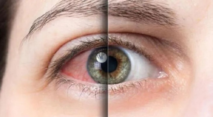 Göz alerjisi kornea ülserine yol açabilir