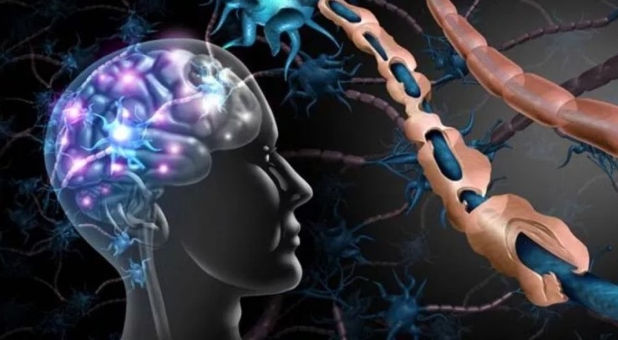 Türkiye'de 35 bin kişi MS hastası