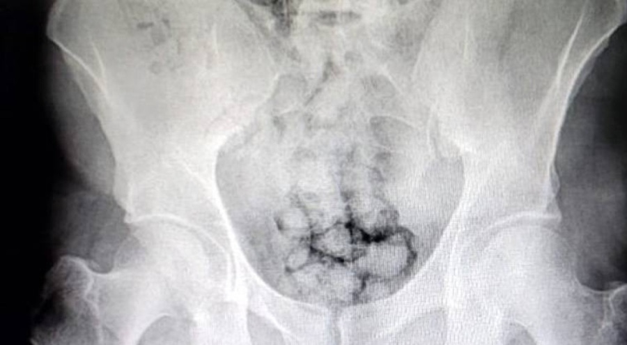 2 kişinin midesinde 60 kapsül uyuşturucu bulundu