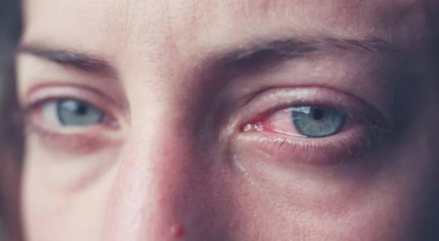 Göz alerjileri, baharın gelmesiyle arttı