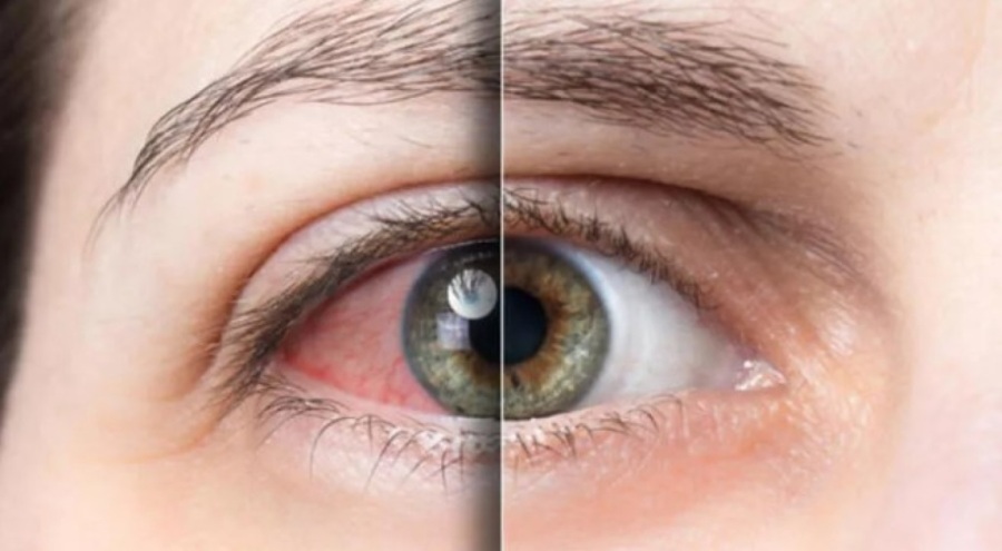 Gözdeki kaşıntının sebebi yağ yiyen kurt olabilir