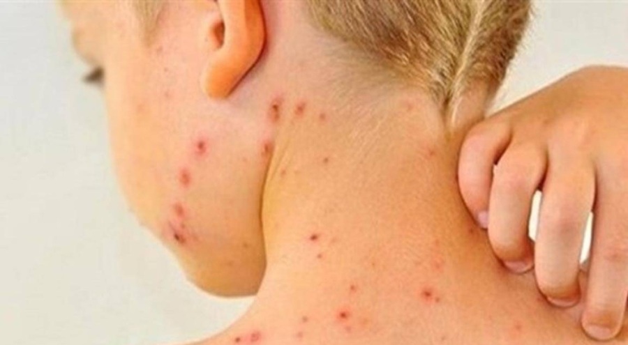 İTO: İstanbul'da kızamık nedeniyle ölen çocuklar var!