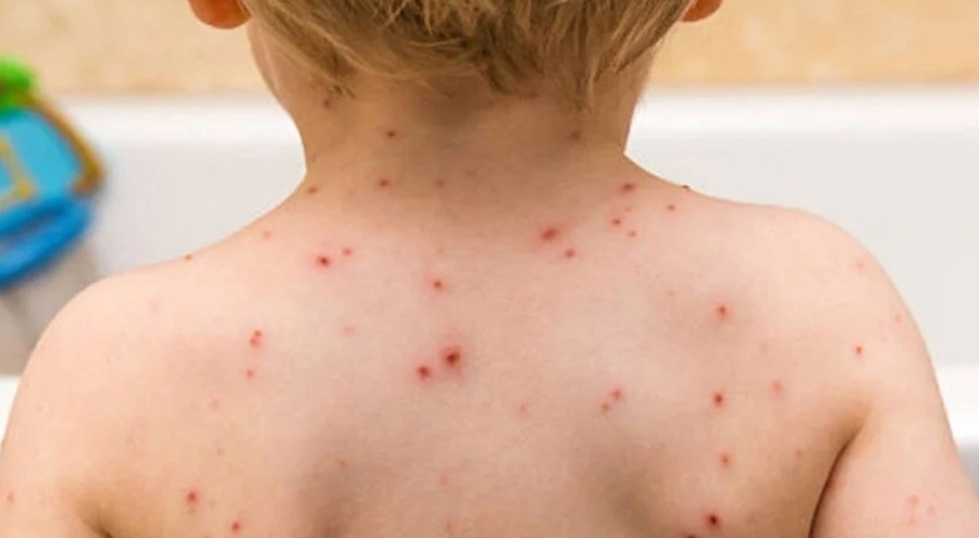 Kızamık alarmı! "Hayatını kaybeden çocuklar var"