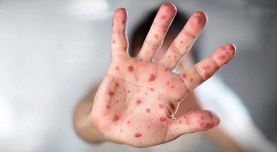 Burhanettin Bulut: Sağlık Bakanlığı, kızamık vakalarını saklıyor