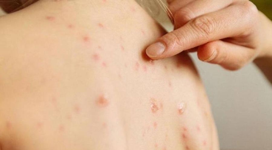 TTB: Bakanlık toplumu kızamık hakkında bilgilendirmeli