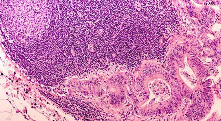 Kolon kanseriyle ilgili dönüm noktası olabilecek keşif!