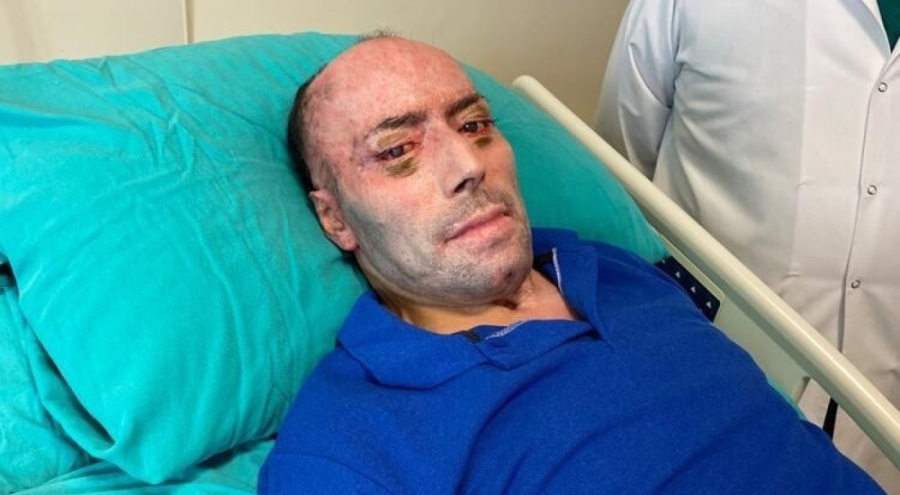 140 ameliyat geçiren maden işçisi tabucu oldu