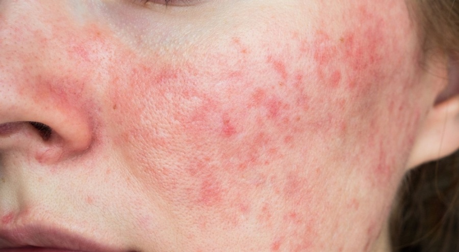 Demodexlere dikkat! Temasla bulaşıyor