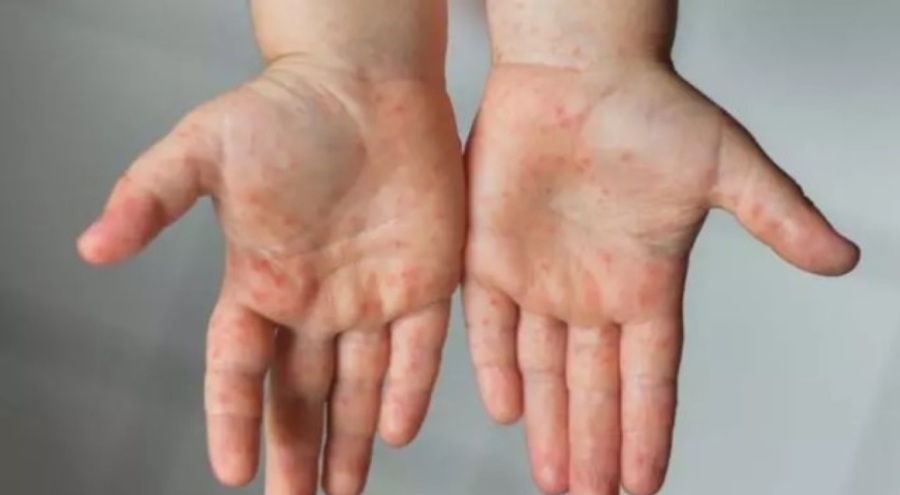 Çocuklarda artan el ayak ağız hastalığına dikkat