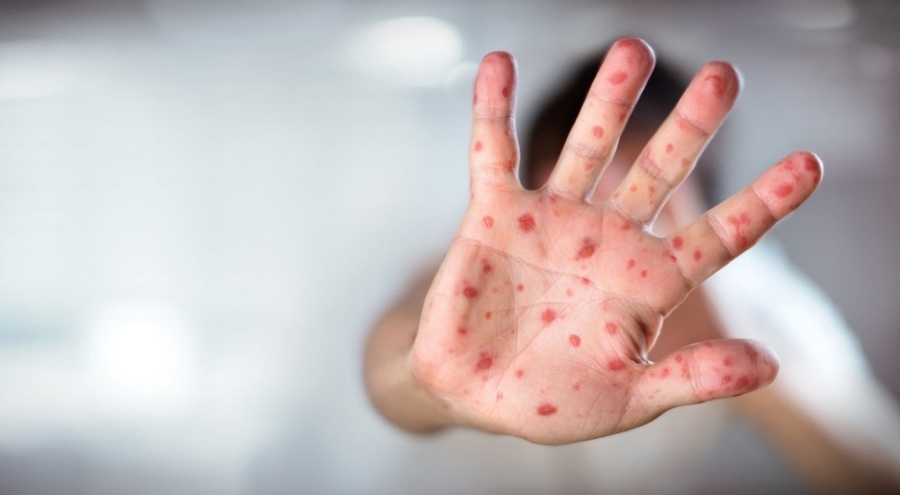 Uzman isim kızamık vakalarındaki artışın nedenini duyurdu