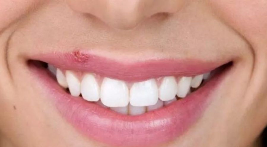 Dikkat uçuk bulaşıcı!