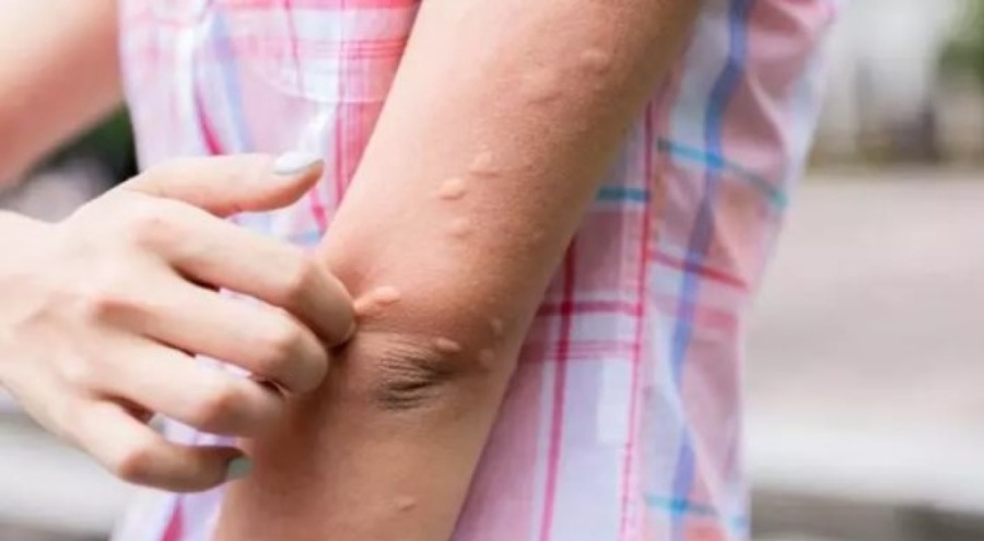 Sivrisinek ısırığına ne iyi gelir?