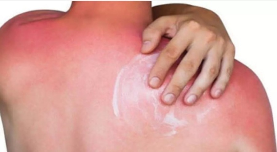 Güneş yanığında sakın bunları yapmayın!