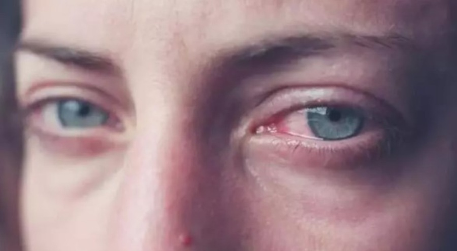 Gözde sulanma ve çapaklanmaya neden olur?