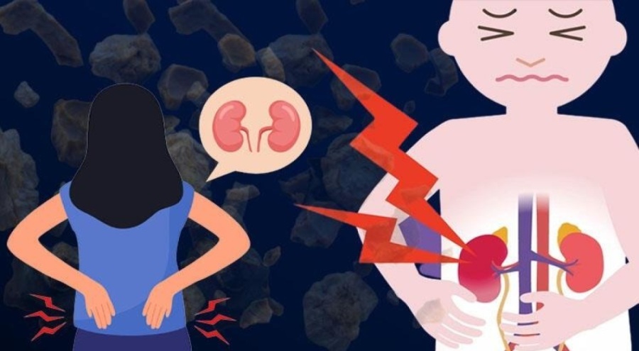 Böbrek taşı vakalarında endişe verici artış!