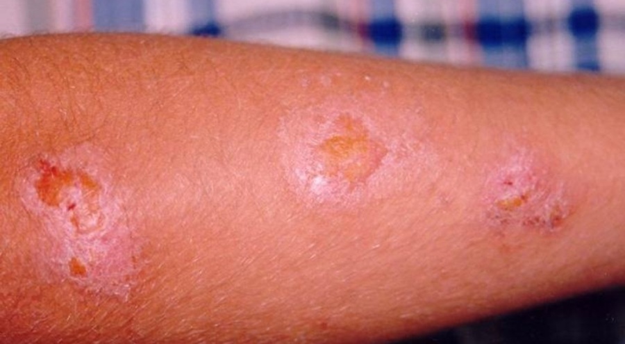 Sıcak havalarda ortaya çıktılar! Uzman isimden kum sineği uyarısı