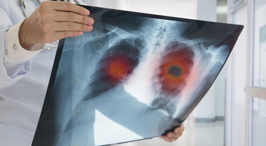 Akciğer kanseri hastalarına kritik uyarı geldi!