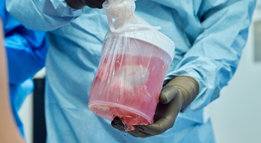 Domuz böbreği, 32 gün boyunca insan vücudunda işlevini yerine getirdi