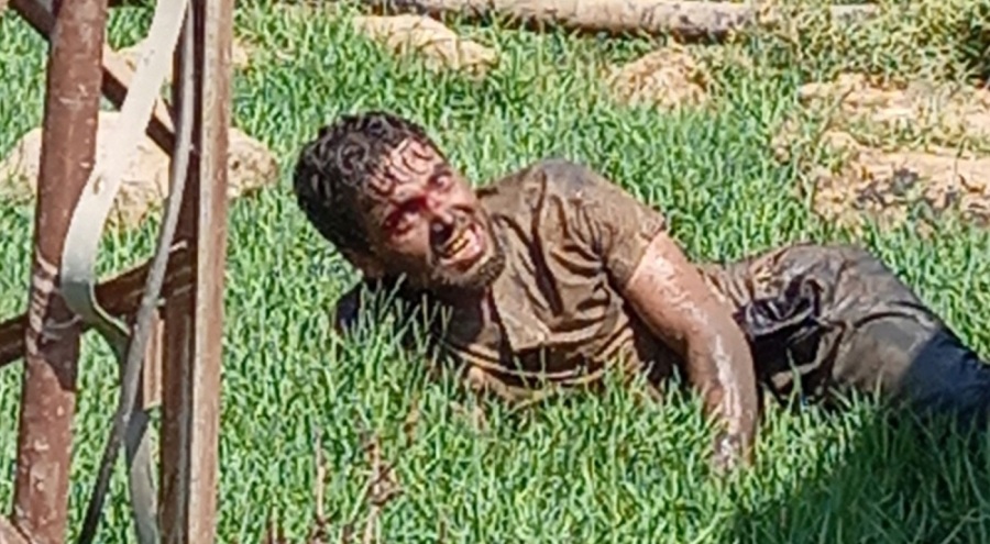 Şanlıurfa'da kuduz hastası yaşamını yitirdi