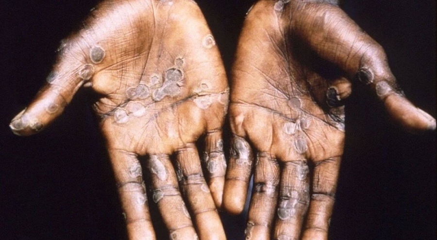 Dünya genelinde 90 binin üzerinde maymun çiçeği virüsü vakası kaydedildi!