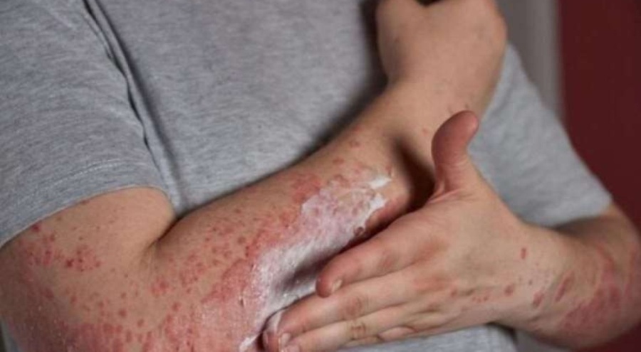 Dilan Polat'ın açıklaması sonrası merak edilen kelebek hastalığı (Lupus) nedir?