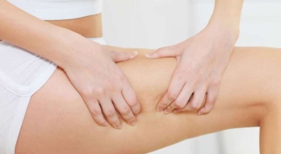 Uzmanından selülit ve çatlakları önlemek için öneri!