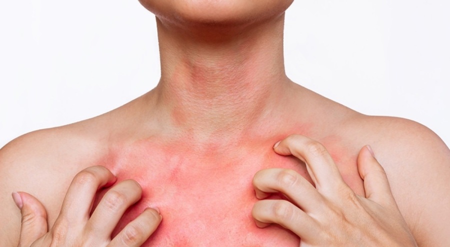 Uyuzda vaka sayısı artıyor! Pandemi, deprem, düzensiz göçmenler etkiliyor