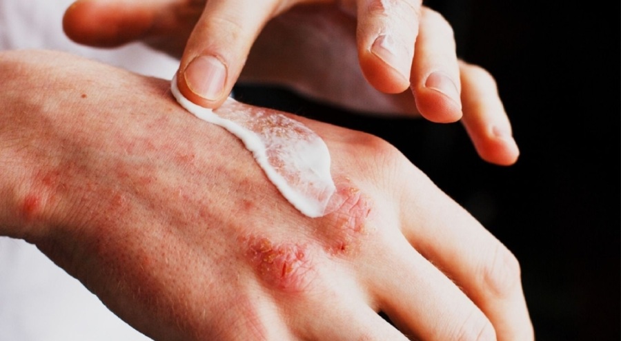 Ellerinizde egzama varsa mutlaka okuyun!