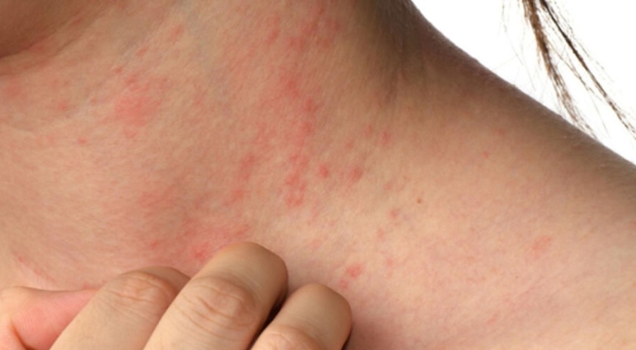 Uyuz vakaları artıyor! İlacı SGK karşılamıyor