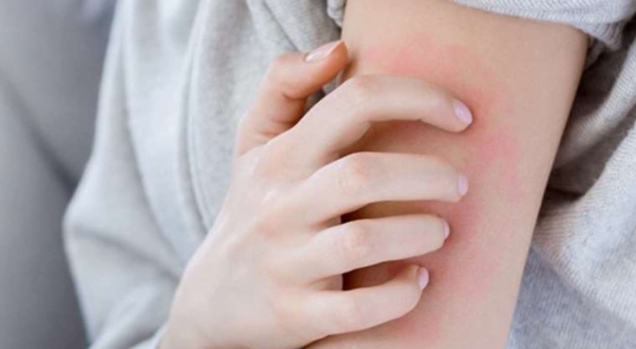 Uzmanlar açıkladı: Uyuz vakaları kaygı verici boyutta